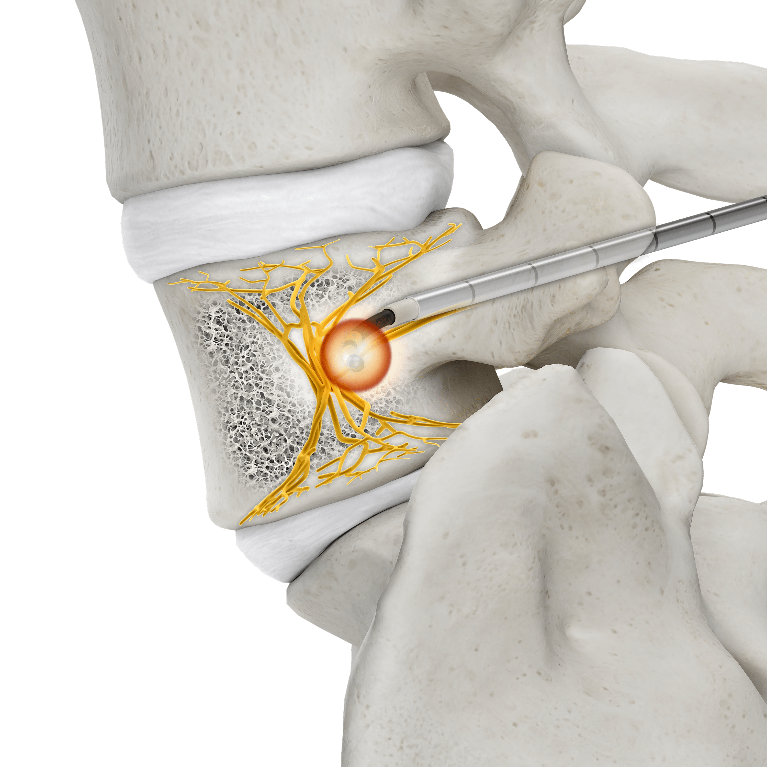 OptaBlate® BVN lateral vertebral body with lesion