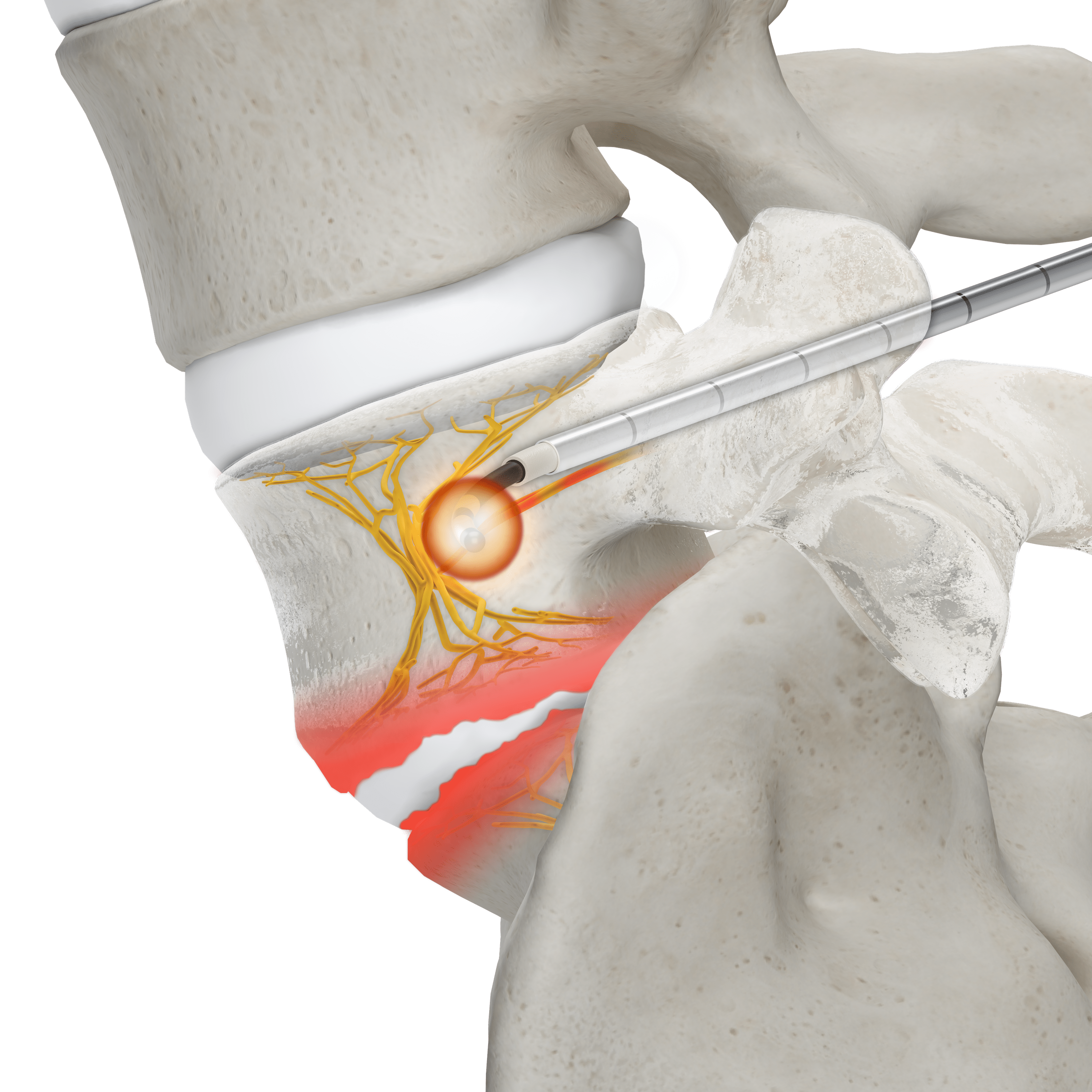 OptaBlate® BVN damaged endplates—with probe